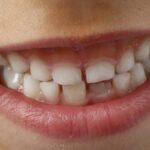 Bleibende Zähne: In welcher Reihenfolge kommen sie?